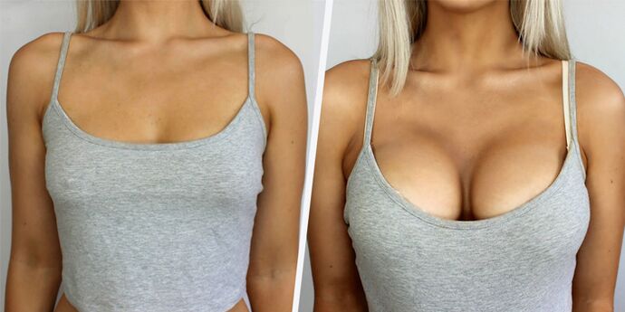 Before and after plastic surgery to enlarge the breast