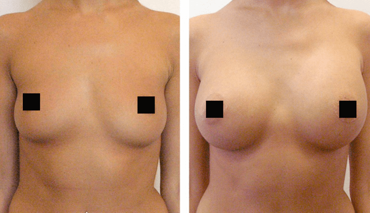 Breast augmentation with hyaluronic acid before and after