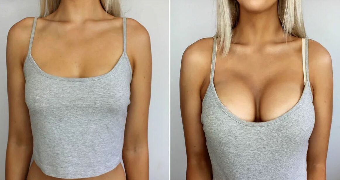 Breast enlargement of 3 size