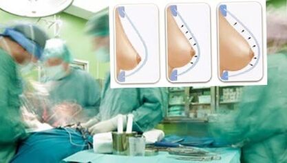 How breast lipilification is performed