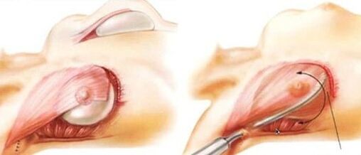 How breast surgery is performed