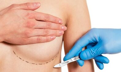 Expansion of breast glands with implants