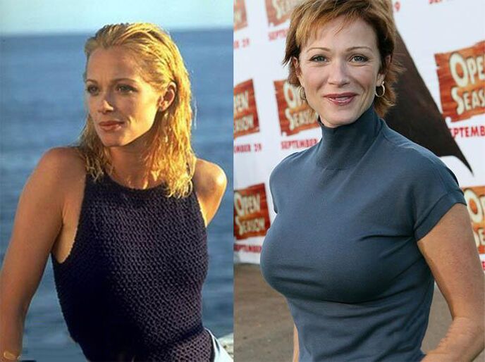 Before and after mammoplasty