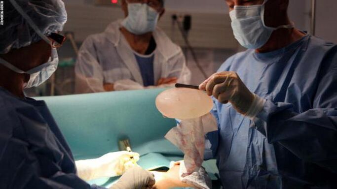 The properties of mammoplasty