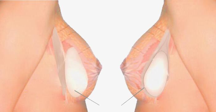 What is mammoplasty
