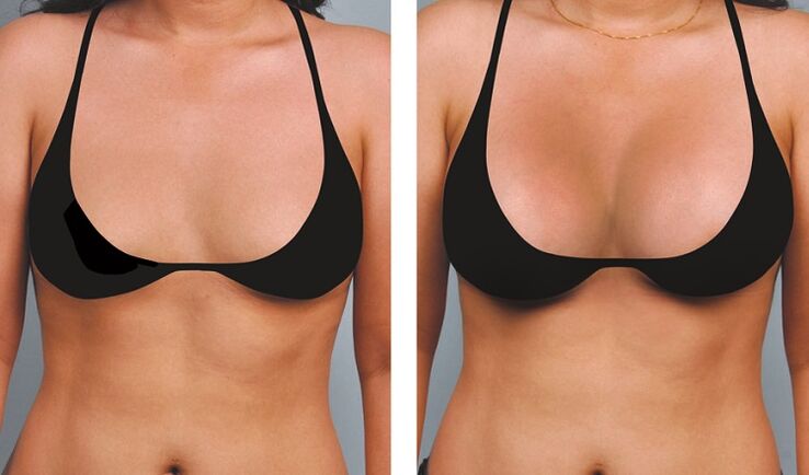 Photos before and after breast augmentation