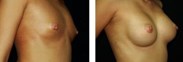 Before and after breast augmentation