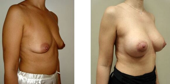 Breast before and after augmentation