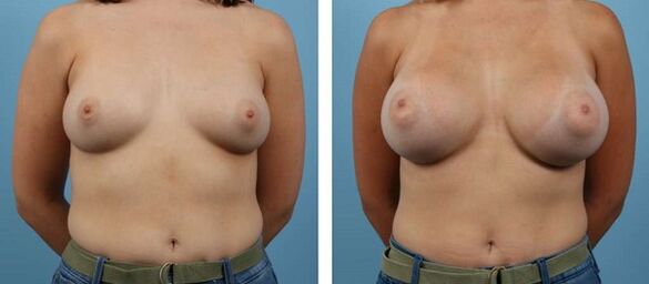 Photos before and after breast augmentation