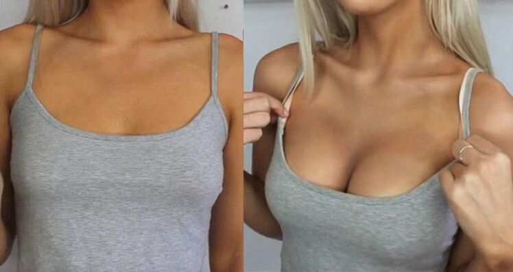 Before and after breast augmentation
