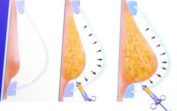 Breast enlargement with fat
