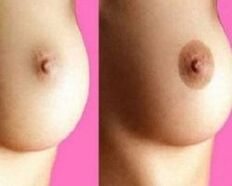 Before and after breast augmentation