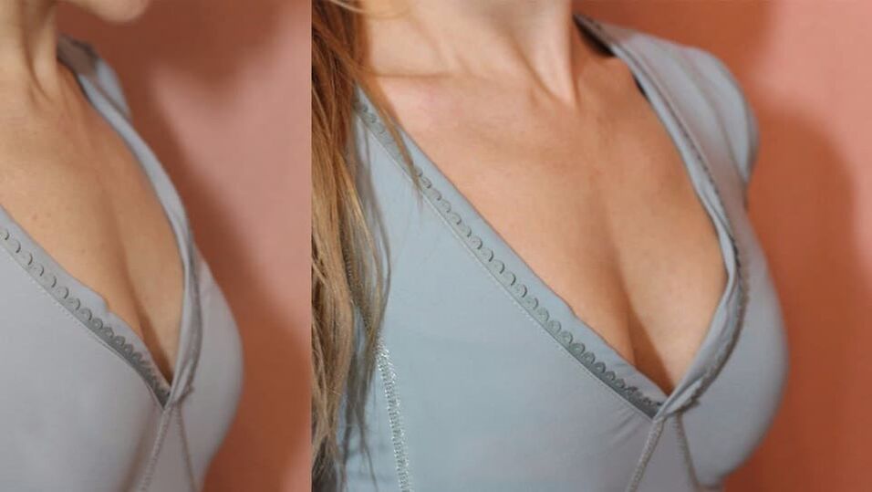 Before and after breast augmentation products