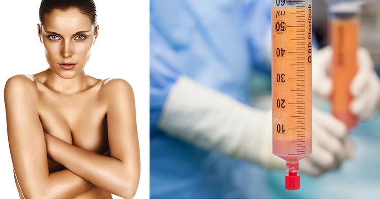 Lipofilling as a method of breast enlargement