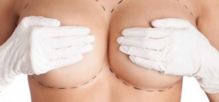 Surgical breast augmentation