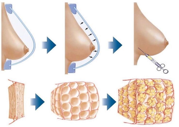 Surgical method of breast enlargement